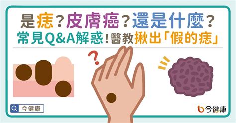 凸痣長毛|是痣or皮膚癌？醫「1張圖秒對照」 長這2部位最危險